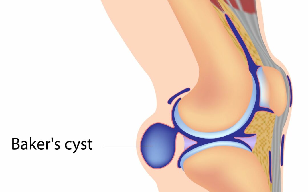 Thinking Practitioner Podcast, Ep 107: Knee Deep: Understanding Baker’s Cysts (with Whitney Lowe & Til Luchau)